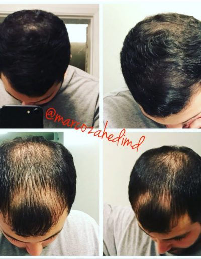Hair Restoration treatment before & after
