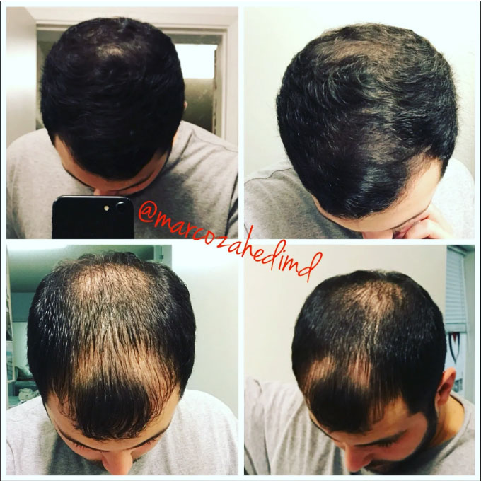 Hair Restoration treatment before & after