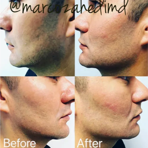 Skin Care Treatment before & after