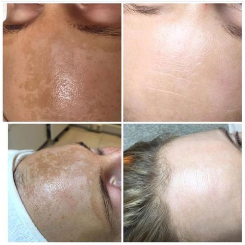 Forehead Skin Treatment Before & After