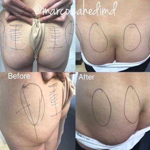 Buttocks Skin treatment before & after