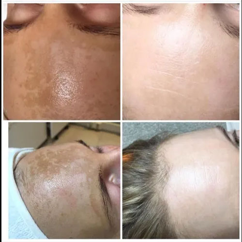 Skin treatment before & after
