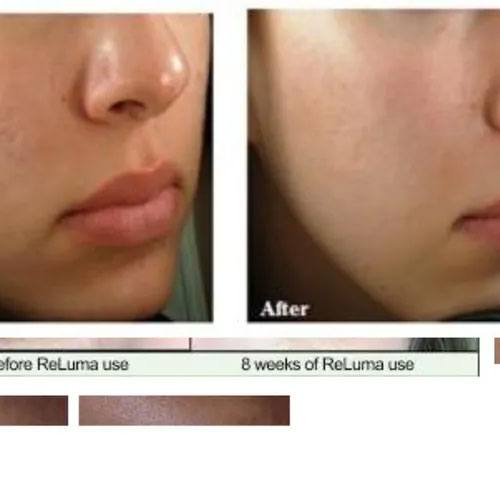 Skin treatment before & after