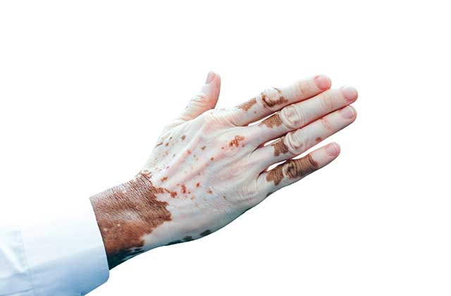 vitiligo